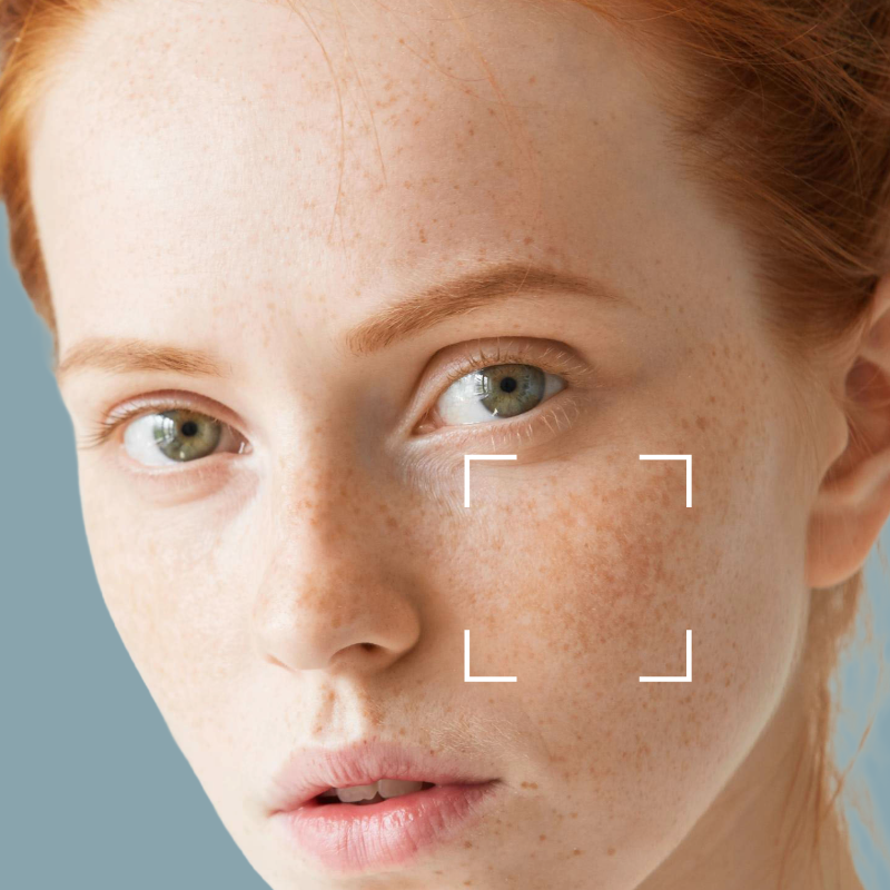 Dry and Dehydrated Skin